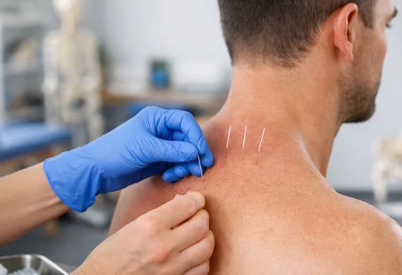 Dry Needling